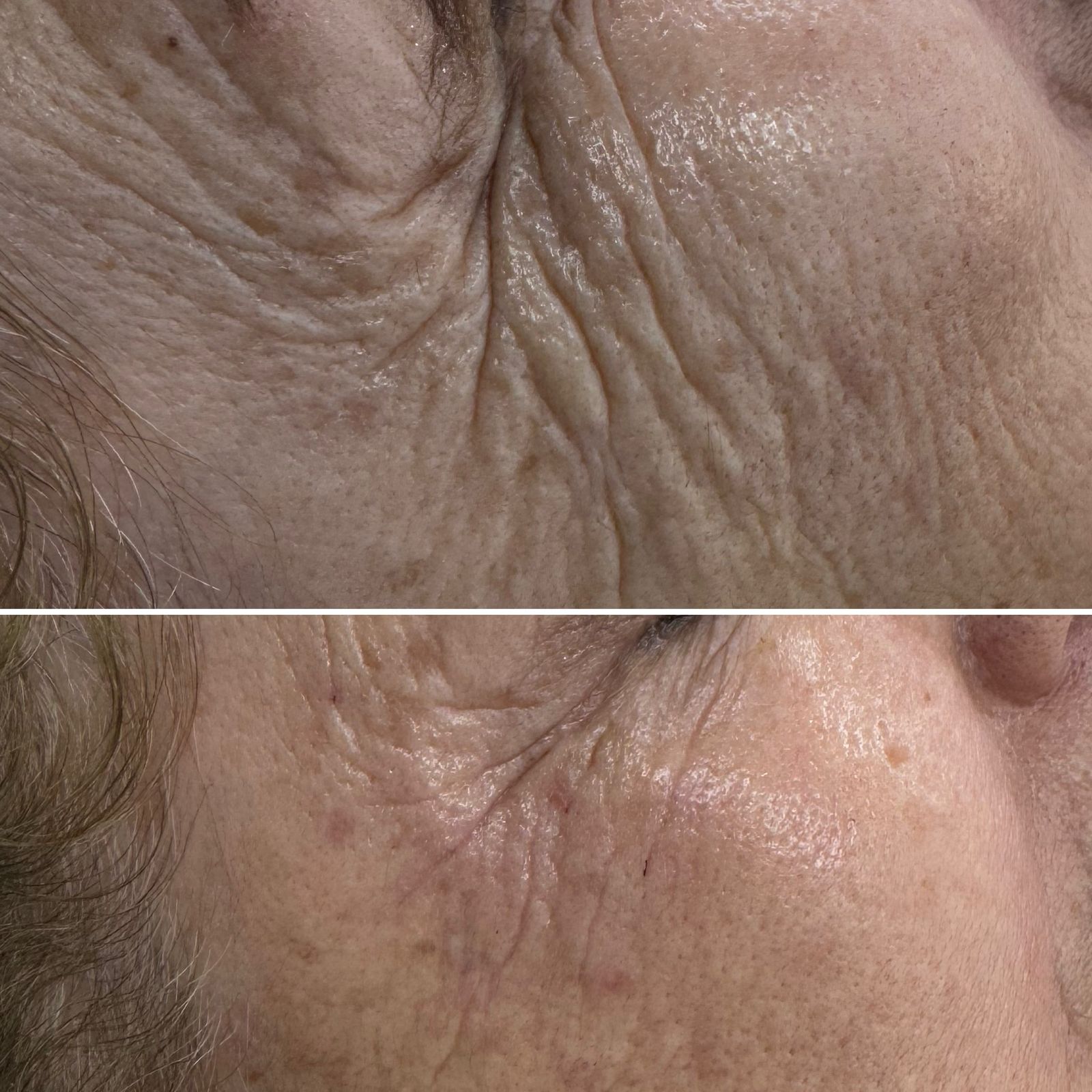 antes y despues CG STYLER ZONA PERIOCULAR (2)